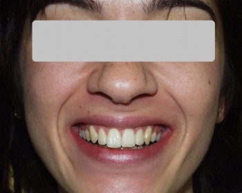 9-xamogela-after-spathis-orthodontics-athens-athina