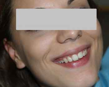 12-xamogela-after-spathis-orthodontics-athens-athina
