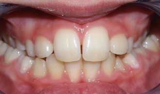 amfipleuri-stauroeidis-siglisi-before-spathis-orthodontics-athens-ampelokipoi