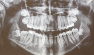 eglistoi-kinodontes-after-spathis-orthodontics-athens-ampelokipoi