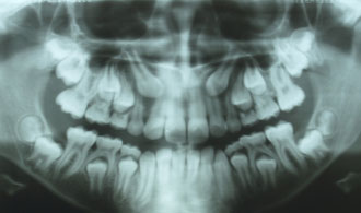 eglistoi-kinodontes-before-spathis-orthodontics-athens-ampelokipoi