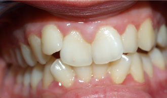 entonos-sinostismos-ano-kato-gnathos-before-spathis-orthodontics-athens-ampelokipoi