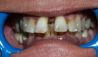 periodontika-dontia-before-spathis-orthodontics-athens-ampelokipoi