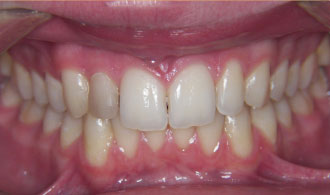 siggenis-eleipsi-dontion-after-spathis-orthodontics-athens-ampelokipoi