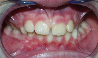 stauroeidis-siglisi-aristera-before-spathis-orthodontics-athens-ampelokipoi