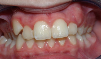 stauroeidis-siglisi-deksia-before-spathis-orthodontics-athens-ampelokipoi