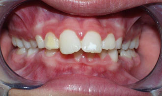 vatheia-diksi-before-spathis-orthodontics-athens-ampelokipoi