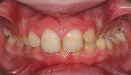 stauroeidis-sigkleisi-spathis-orthodontics-athens-ampelokipoi