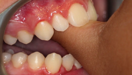 thilasmos-daktilou-spathis-orthodontics-athens-ampelokipoi