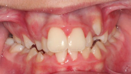 sinostismos-dontion-spathis-orthodontics-athens-ampelokipoi