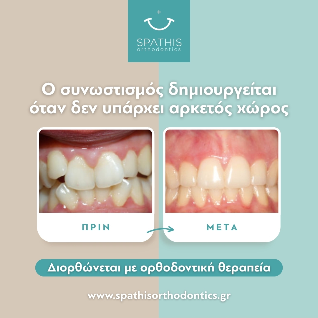 Συνωστισμός Δοντιών: Αίτια & Λύσεις