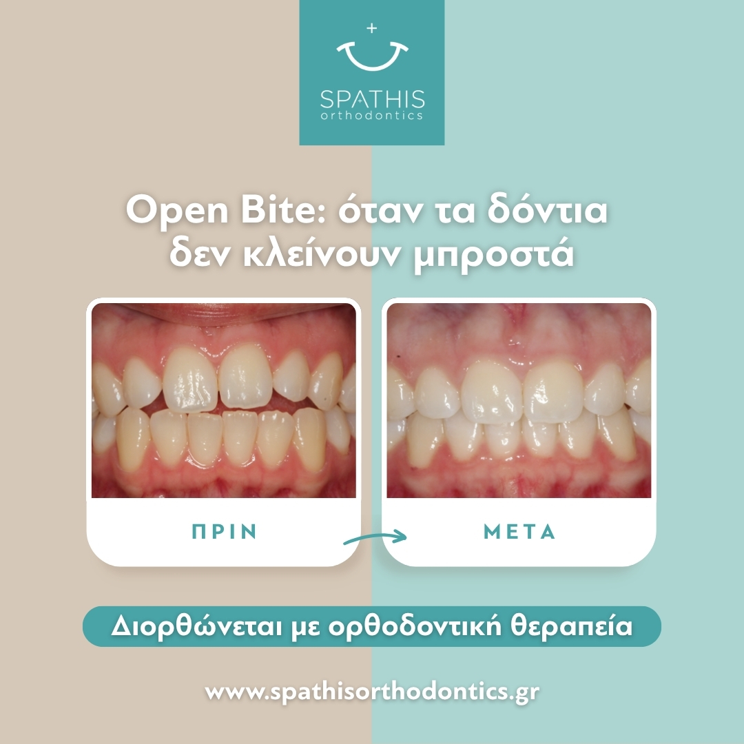 Open Bite: Διάγνωση & Θεραπεία