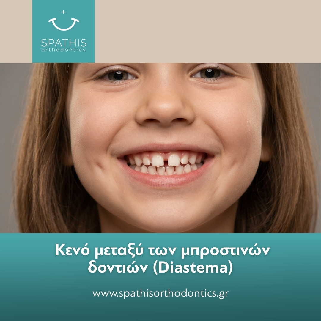 Διάστημα (Diastema): Αίτια & Διόρθωση