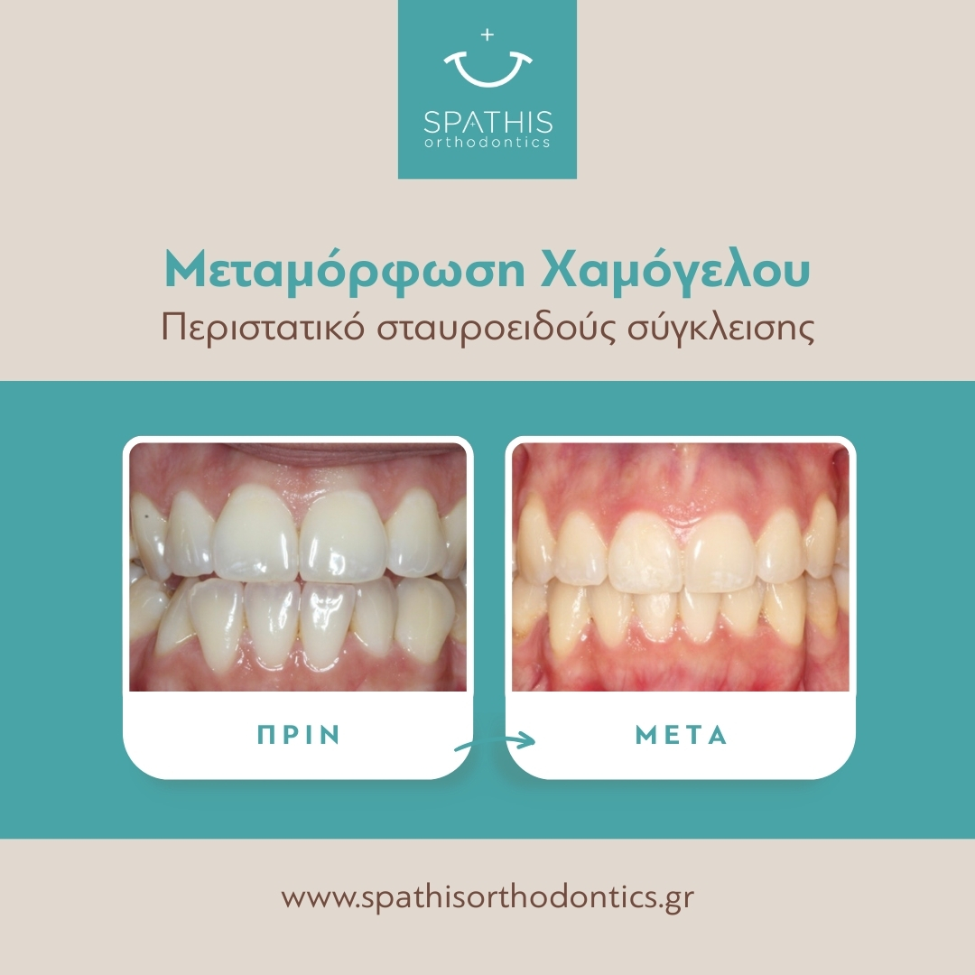 Σταυροειδής Σύγκλειση – Crossbite