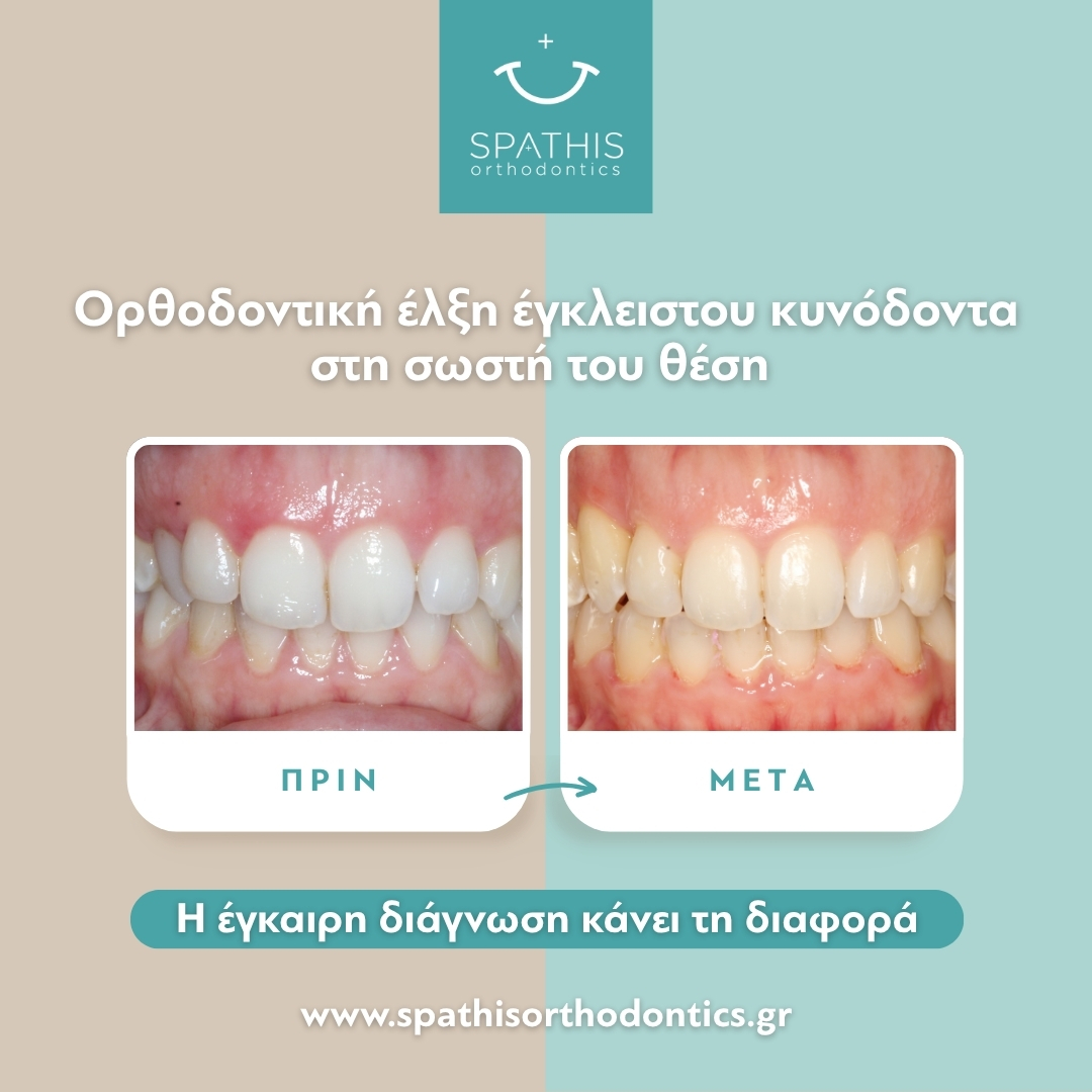 Έγκλειστοι Κυνόδοντες: Γιατί χρειάζονται έγκαιρη αντιμετώπιση