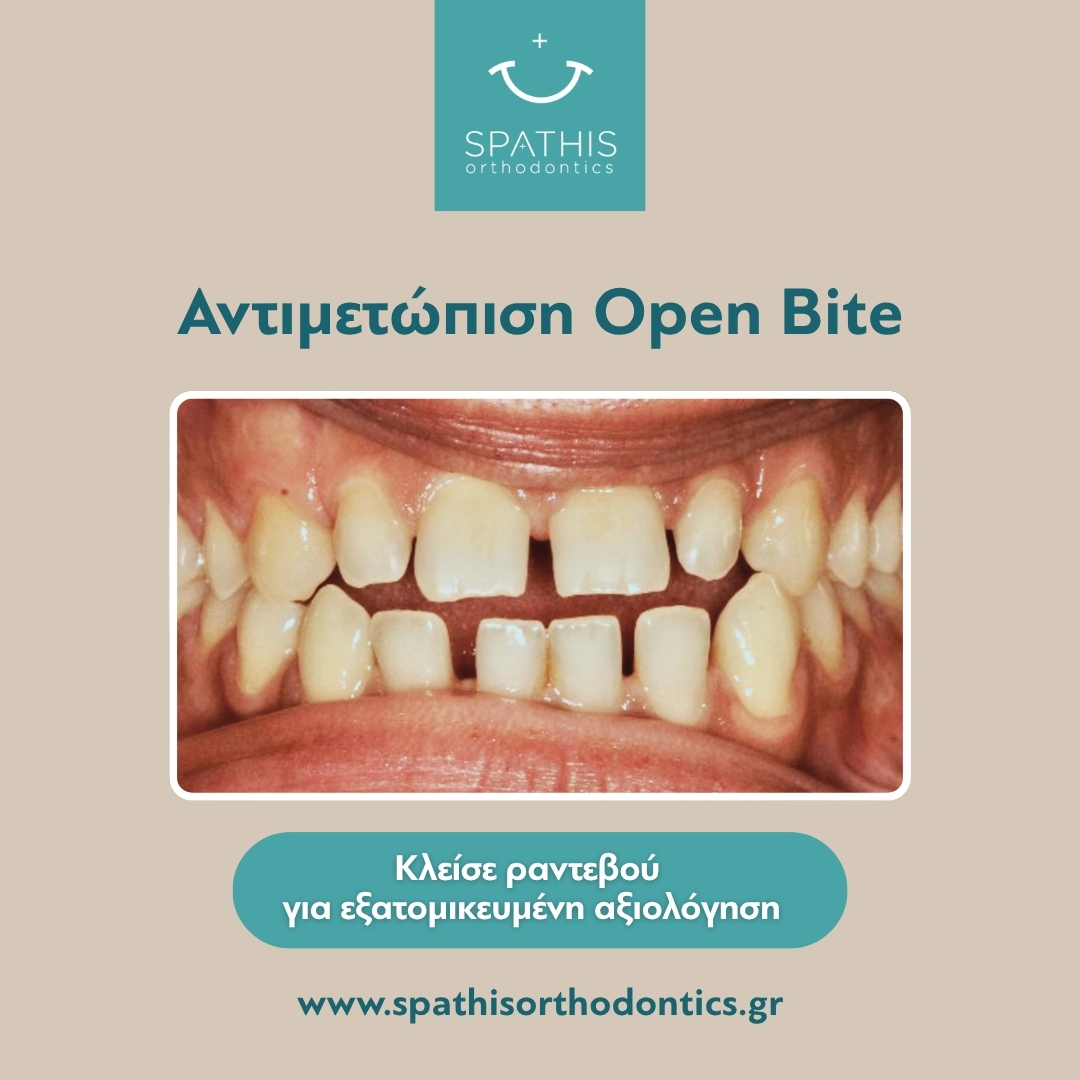 Αντιμετώπιση Open Bite